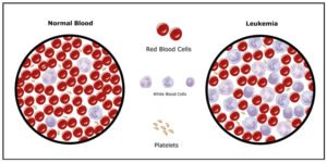Read more about the article Chronic Myeloid Leukemia