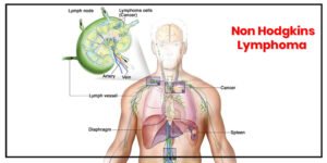 Read more about the article Non-Hodgkin’s Lymphoma
